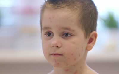 Windpockenfälle – Windpocken gehören zu den häufigsten Kinderkrankheiten und sind äußerst ansteckend. Daher rät die AOK dazu, insbesondere Kinder gegen Windpocken impfen zu lassen. Foto: AOK/Colourbox/hfr
